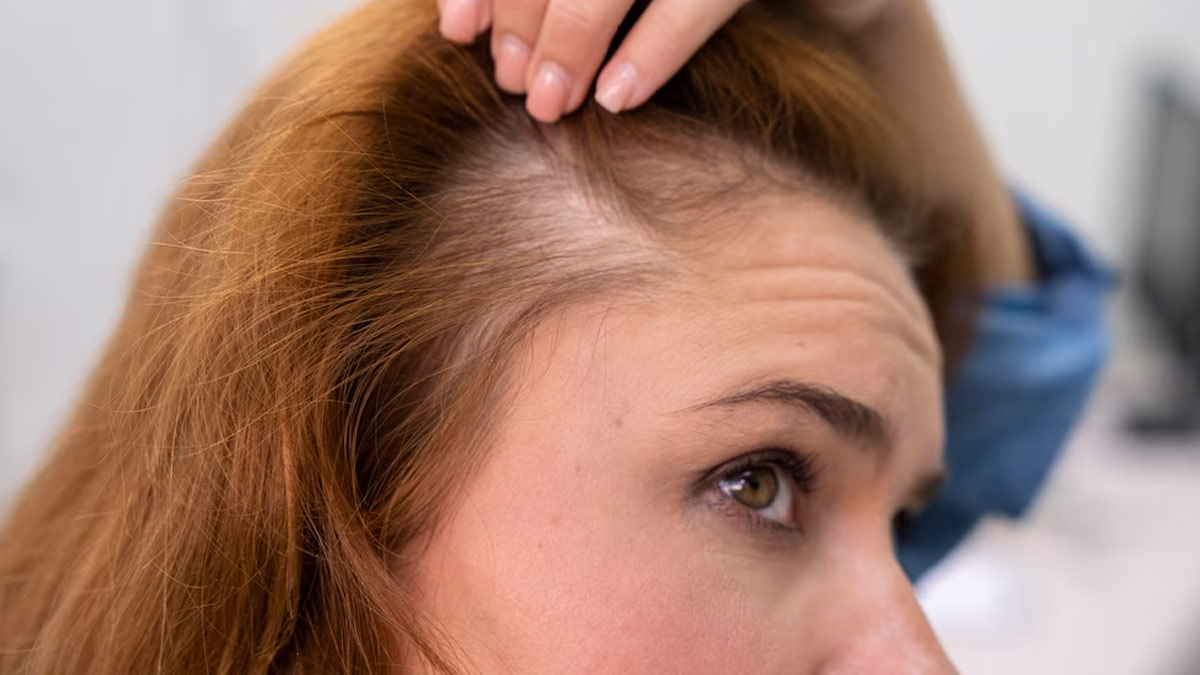 1-receding-hairline