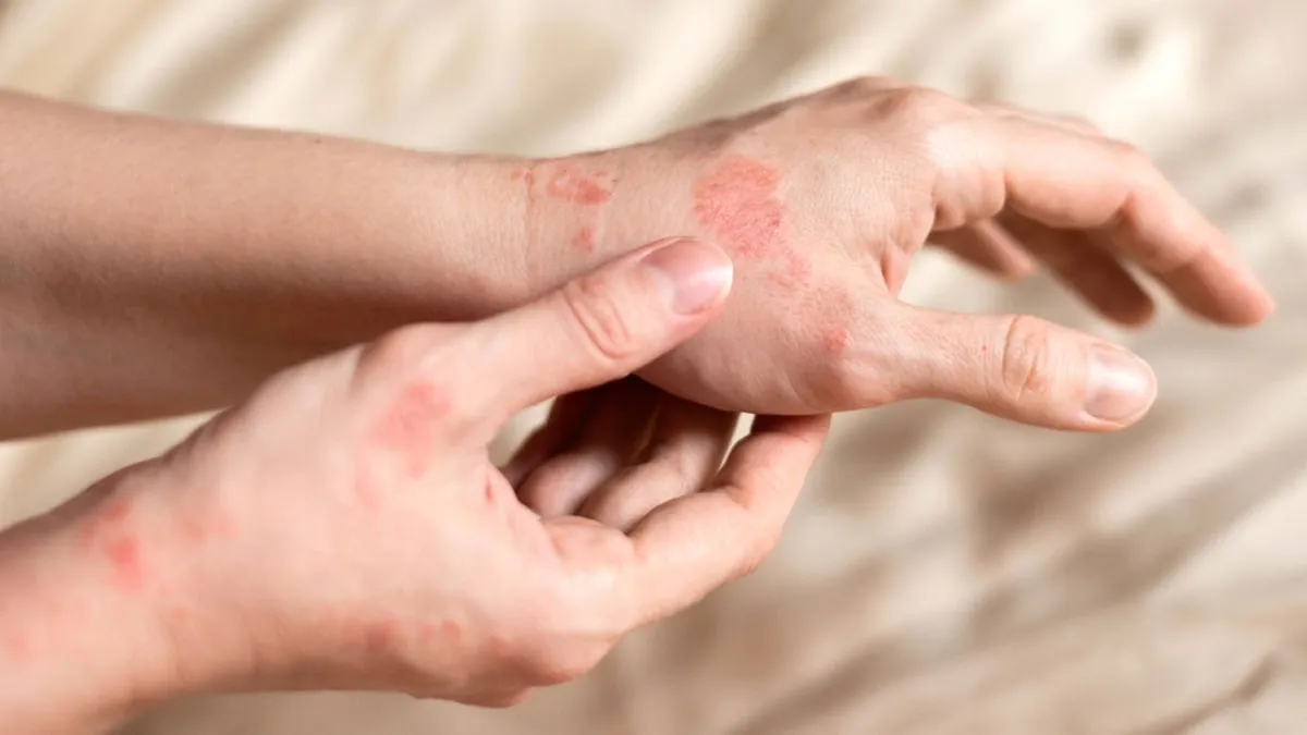 Preventing Eczema Flare-Ups: Here's How Herbal Oils Can Help You Manage It