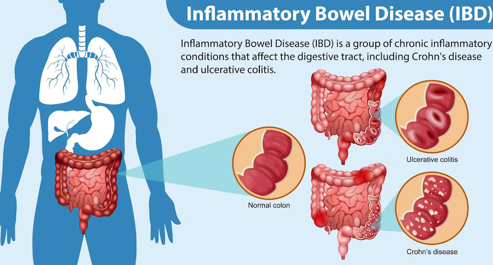 5-IBS
