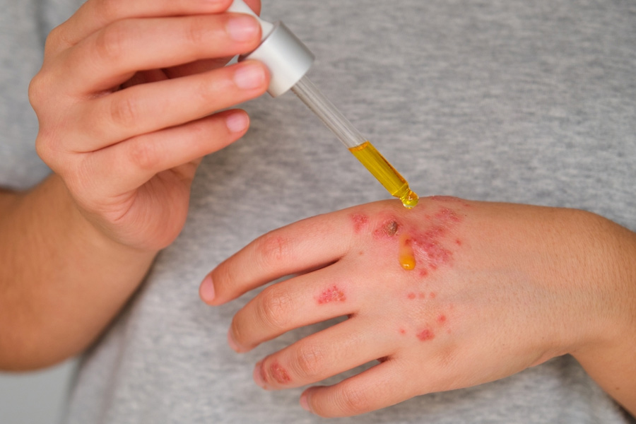 applying-oil-on eczema