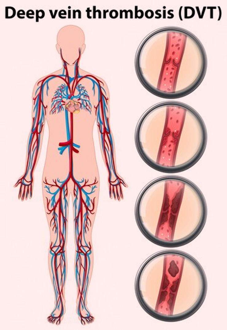 deep-vein-thrombosis