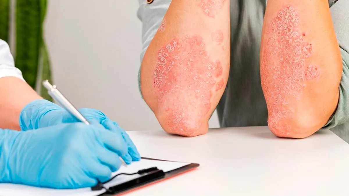 Try THIS If You Have Eczema Or Psoriasis
