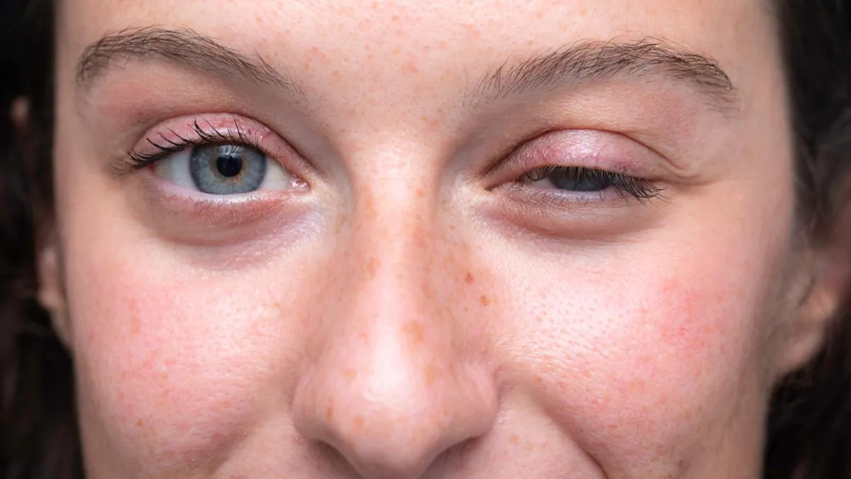 Muscle Weakness Can Signal Myasthenia Gravis - A Condition Without Cure: What Is It And Management Tips