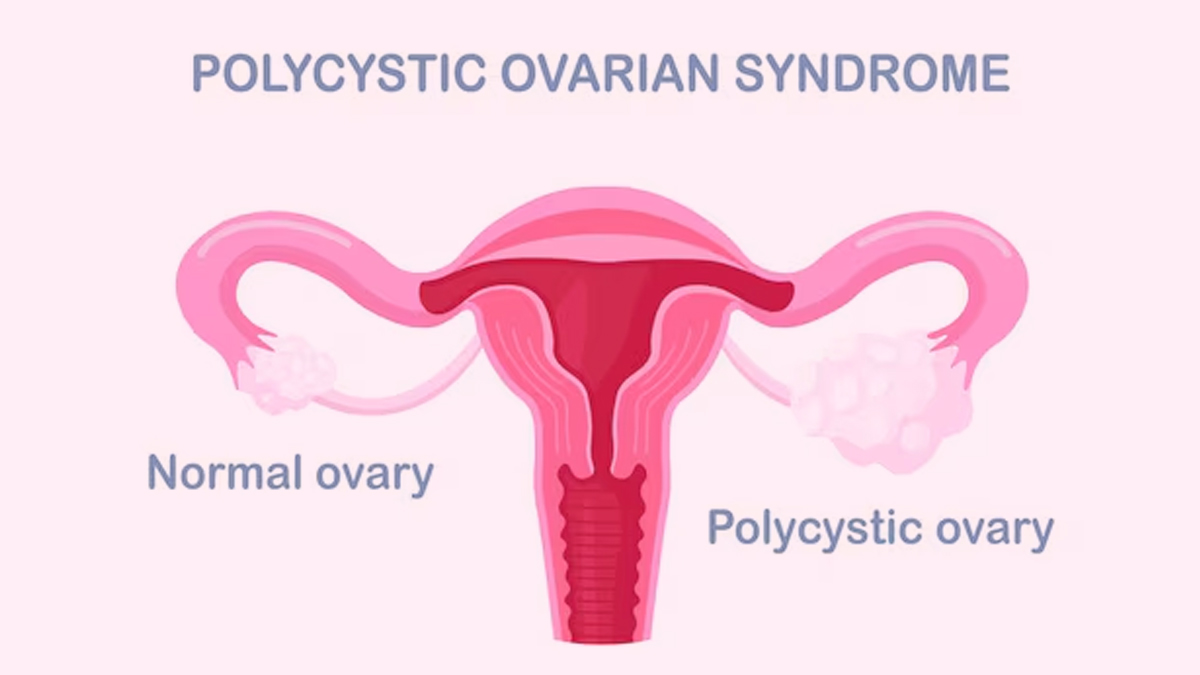 PCOS