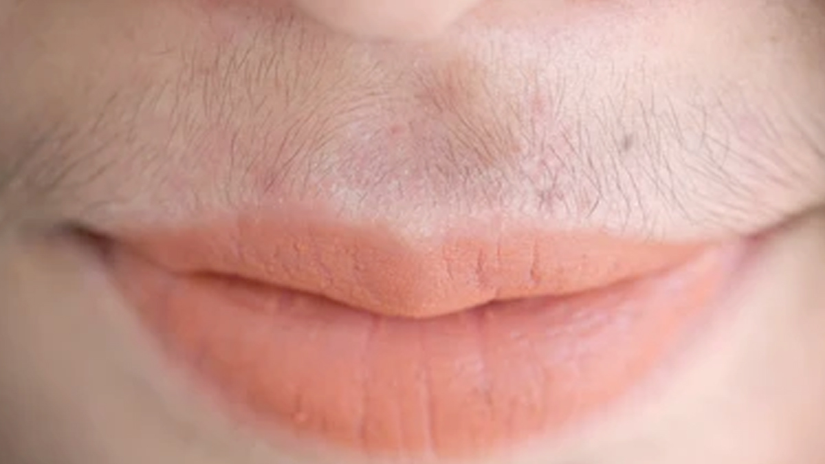 hirsutism