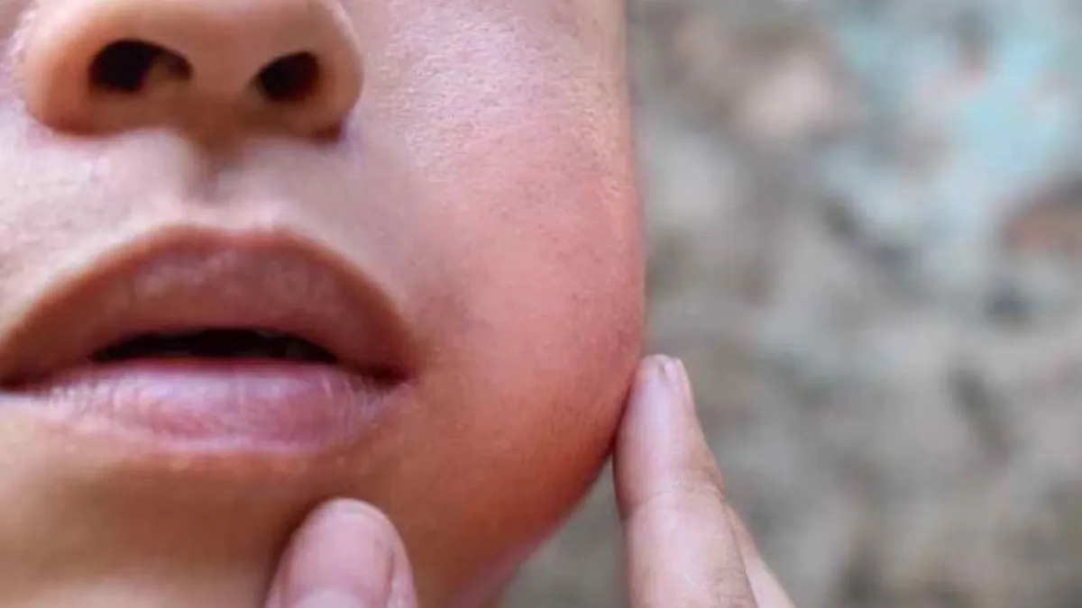 Mumps Outbreak Grips Kerala: Thiruvananthapuram Sees 50+ Daily Cases, Health Officials Sound Alarm