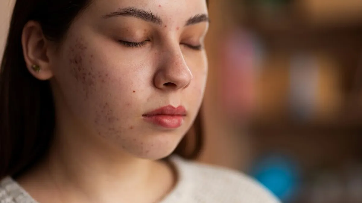 Niacinamide For Dark Spots And Acne Breakouts: How To Add It In Your Skincare Routine