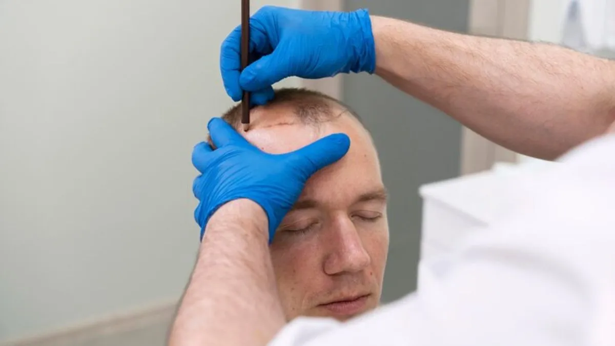 Doctor Speaks: Safety Protocol To Be followed for Hair Transplant Procedures