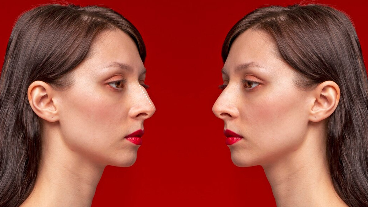 rhinoplasty