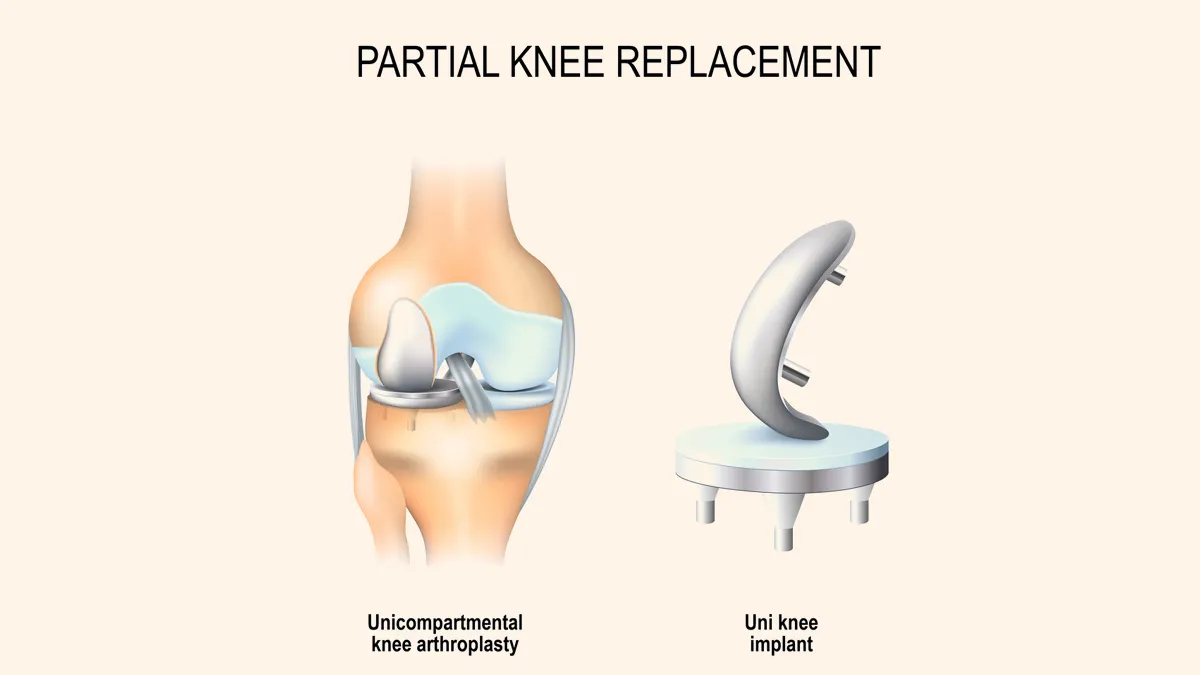 Partial Knee Replacement: Is It Just for the Elderly? Expert Debunks Myths And Reveals The Truth