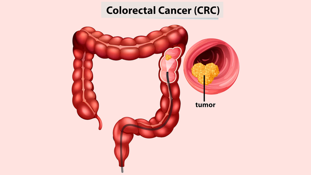 1-bowel-cancer