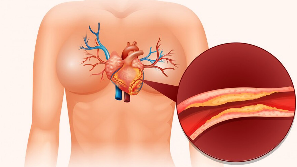From Turmeric To Rosemary: Herbs For Reducing Silent Inflammation In Arteries