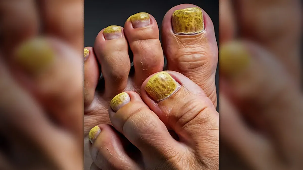 What Is Yellow Nail Syndrome, The Deadly Condition That Causes Breathlessness