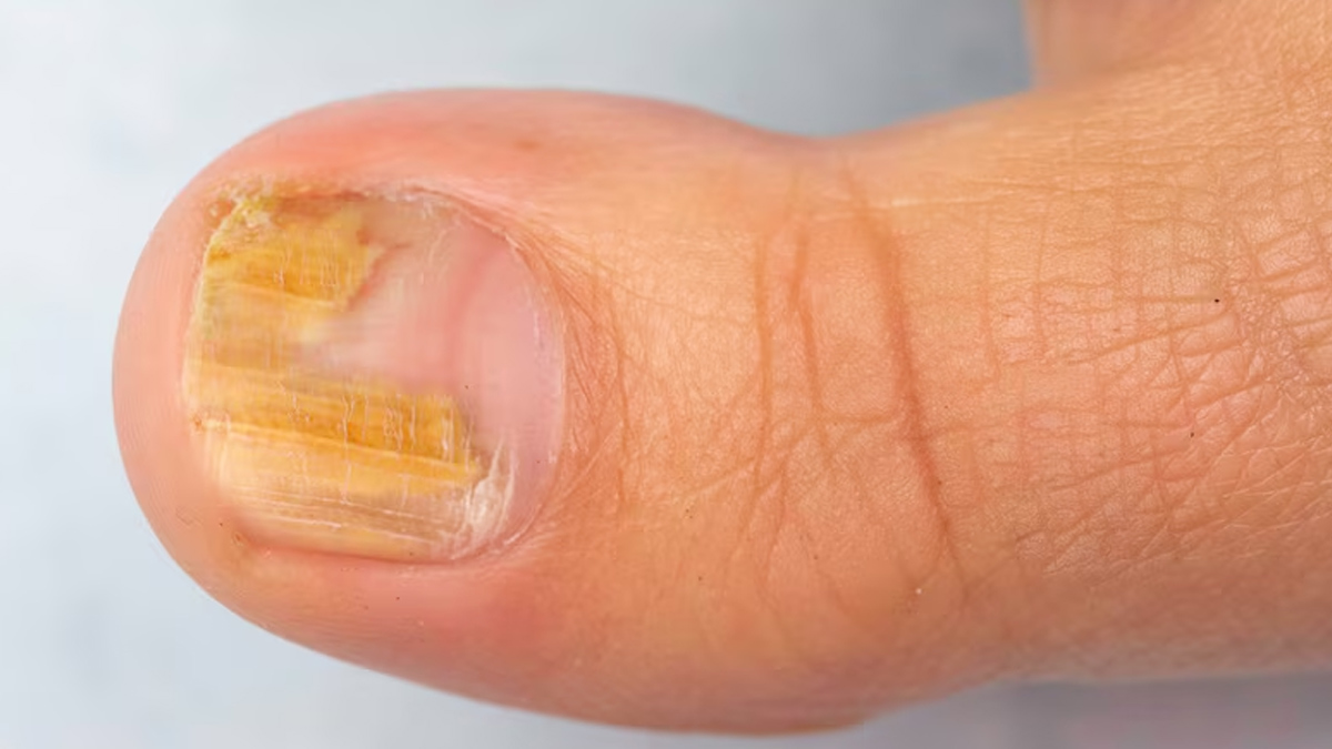 1-yellow-nail-syndrome