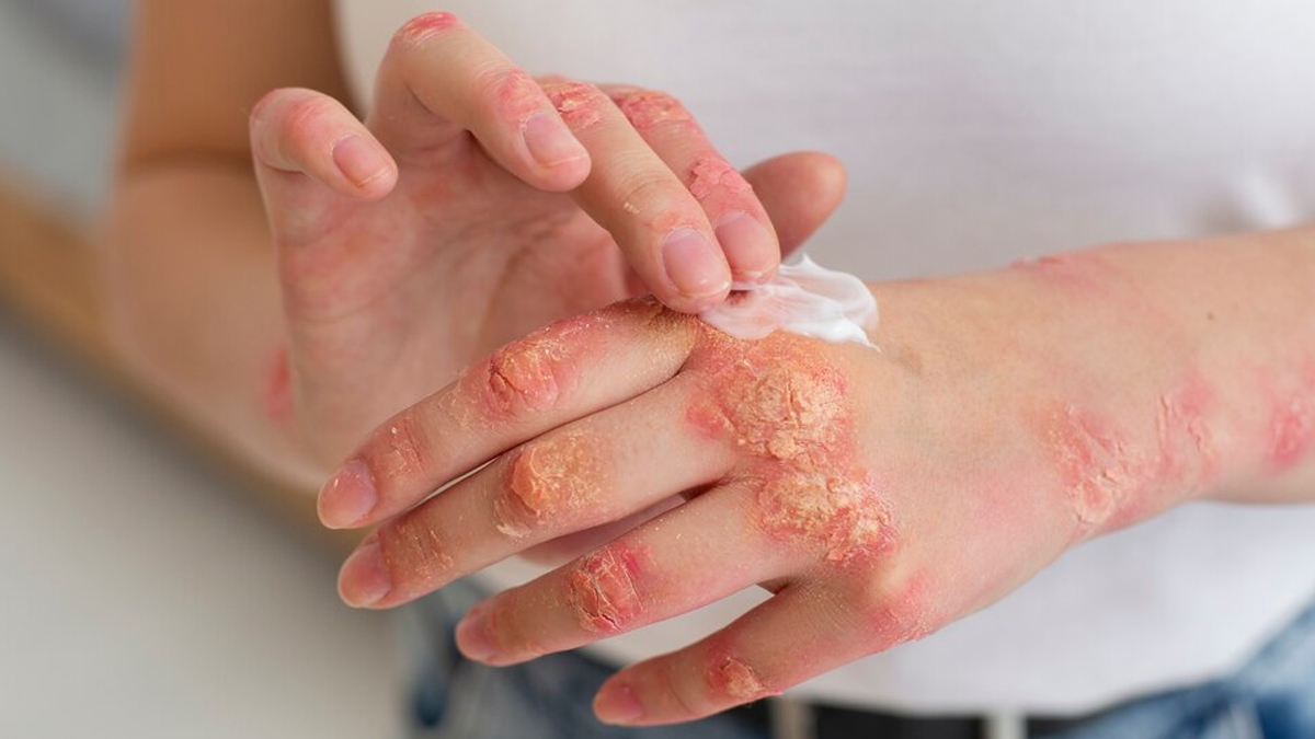 contact-dermatitis