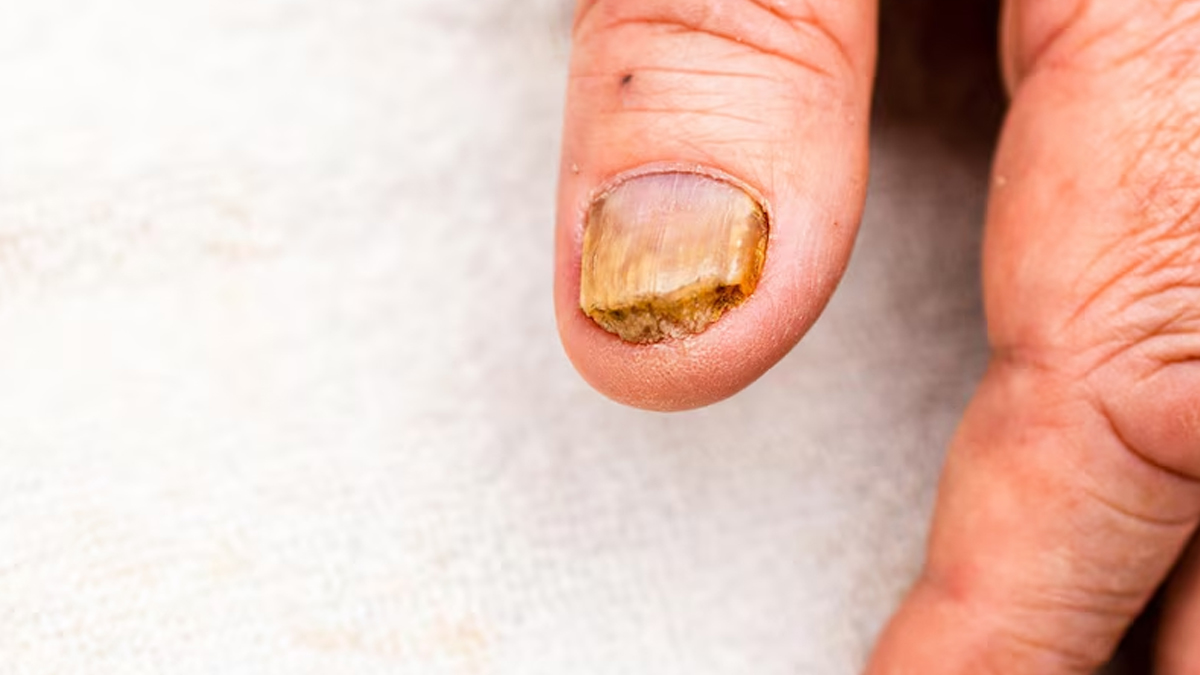 4-yellow-nail-syndrome