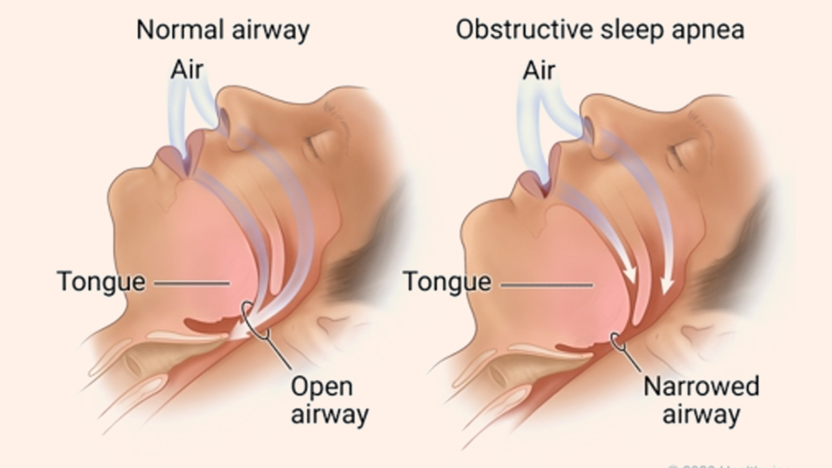 1-Sleep-Apnea