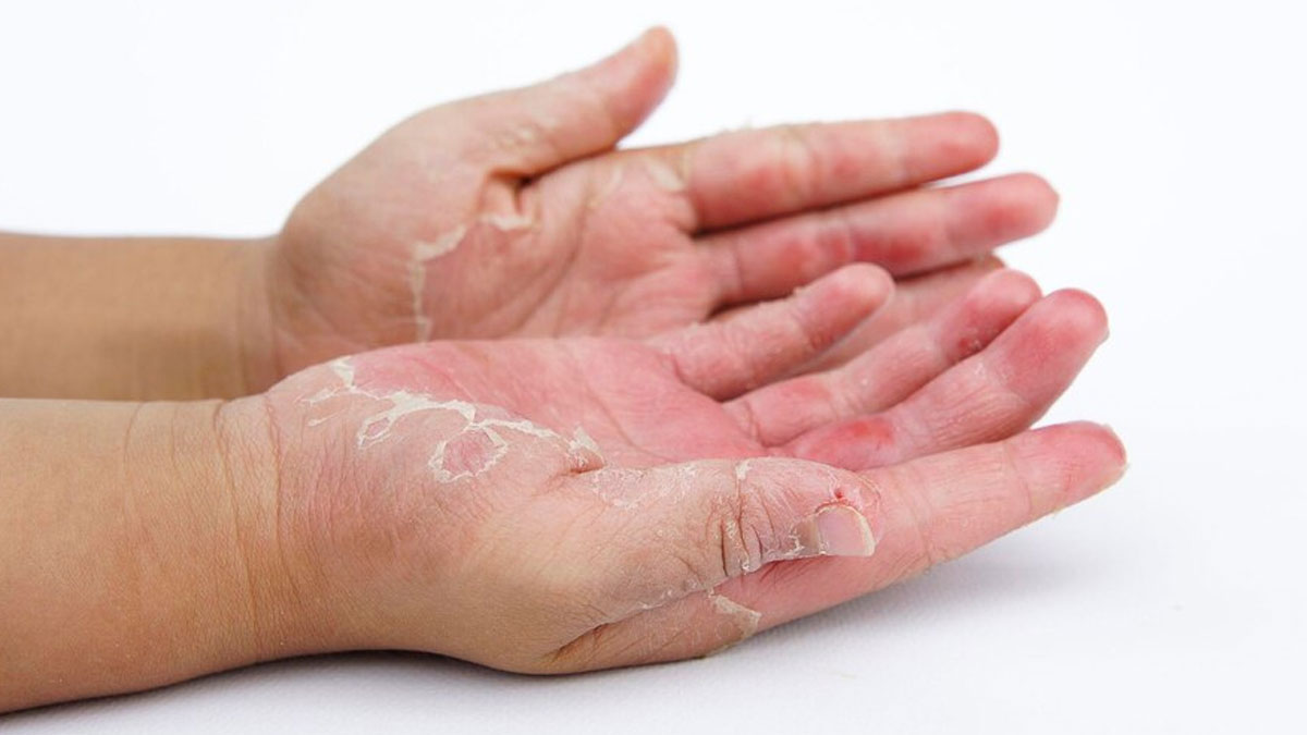 contact-dermatitis