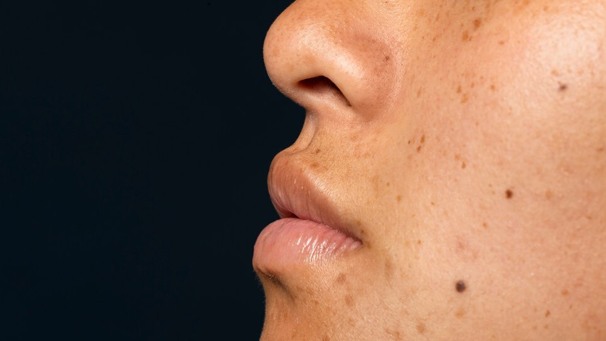 hyperpigmentation