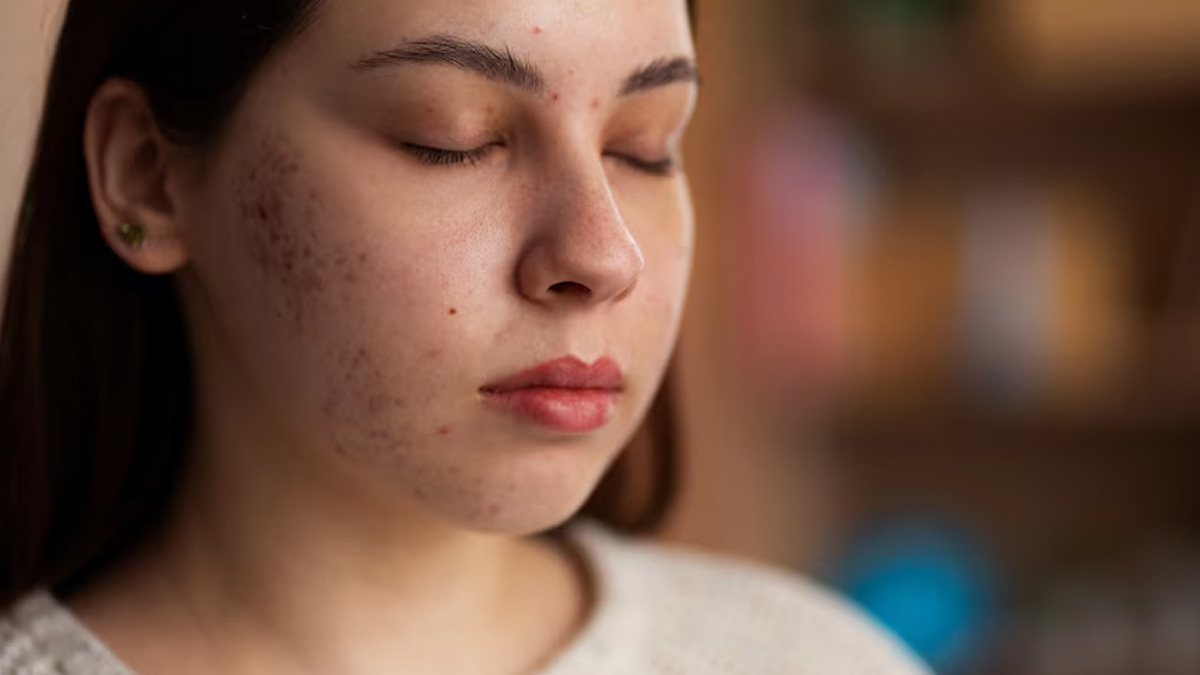 Can Pimple Breakouts Be A Symptom of Skin Cancer? | OnlyMyHealth