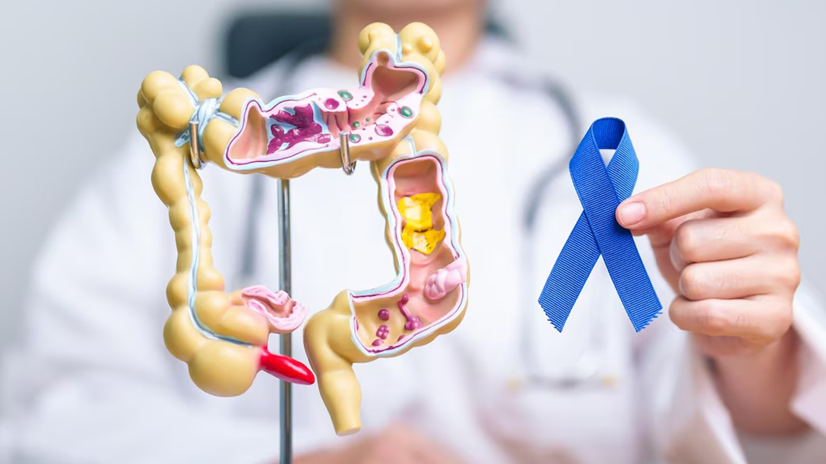 colon-cancer