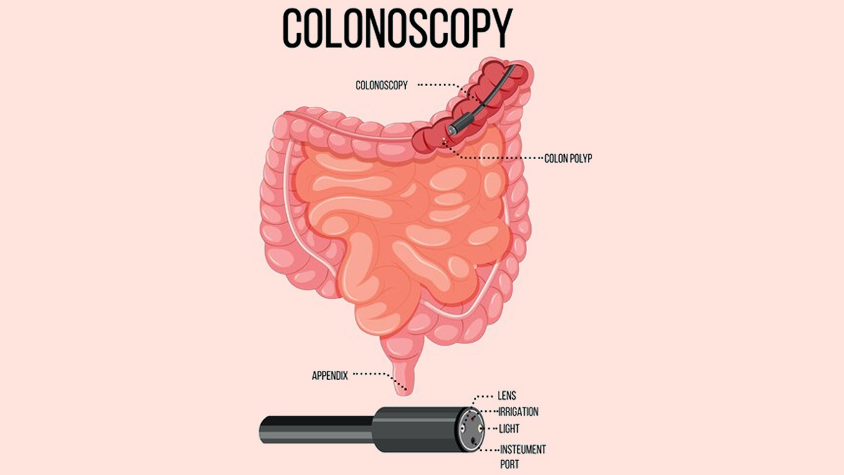 colonoscopy