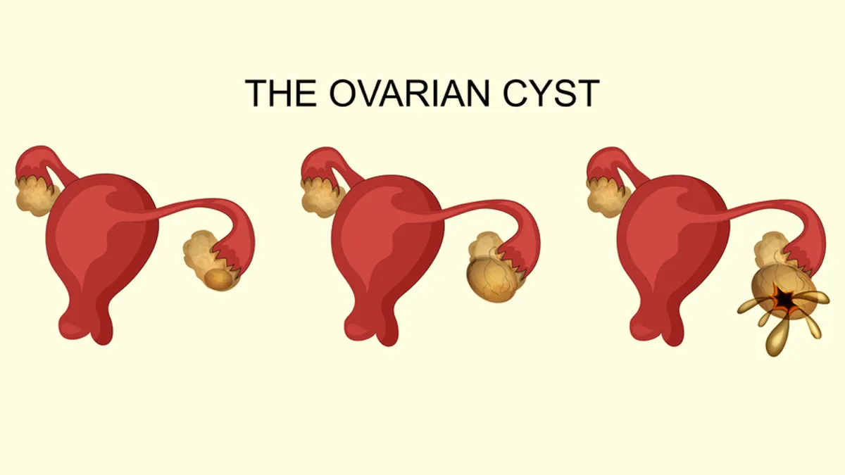 Ruptured Ovarian Cysts: What They Feel Like And How to Deal With Them
