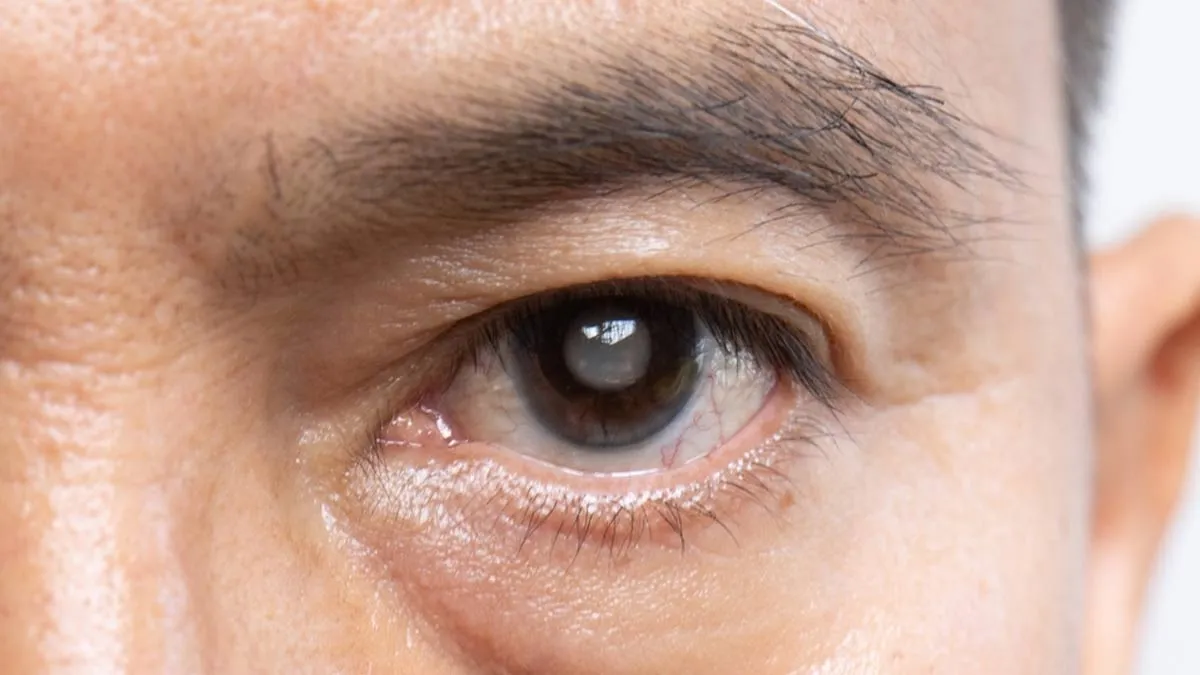 Can Pollution Increase Cataract Risk? Ophthalmologist Explains