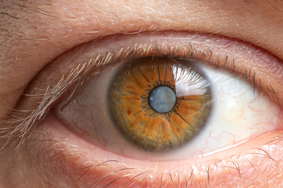 1-pollution-and-cataract