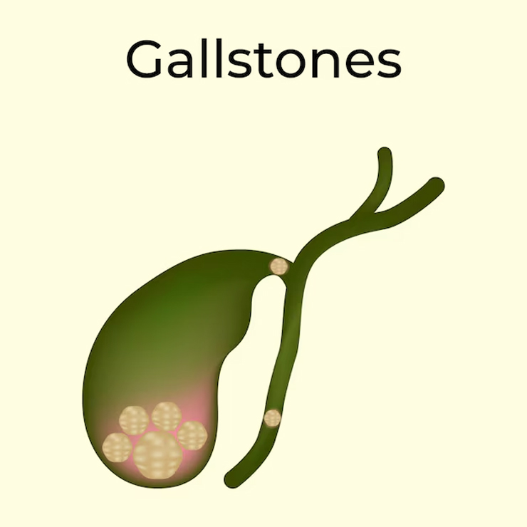 gallstones