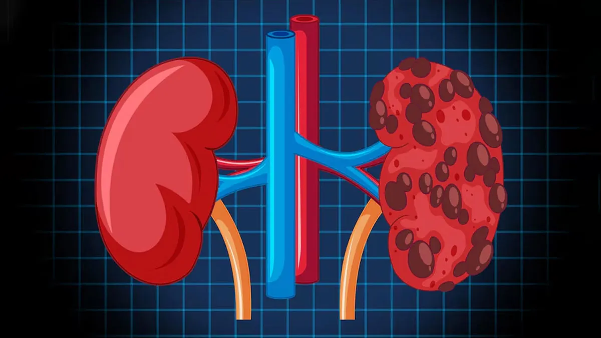 Why Do Kidney Stone Cases Spike In Winters? Doctor Shares Tips To Manage And Prevent It