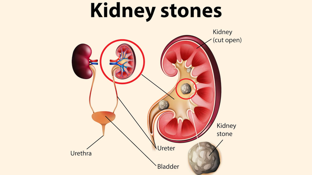 1-kidney-stones