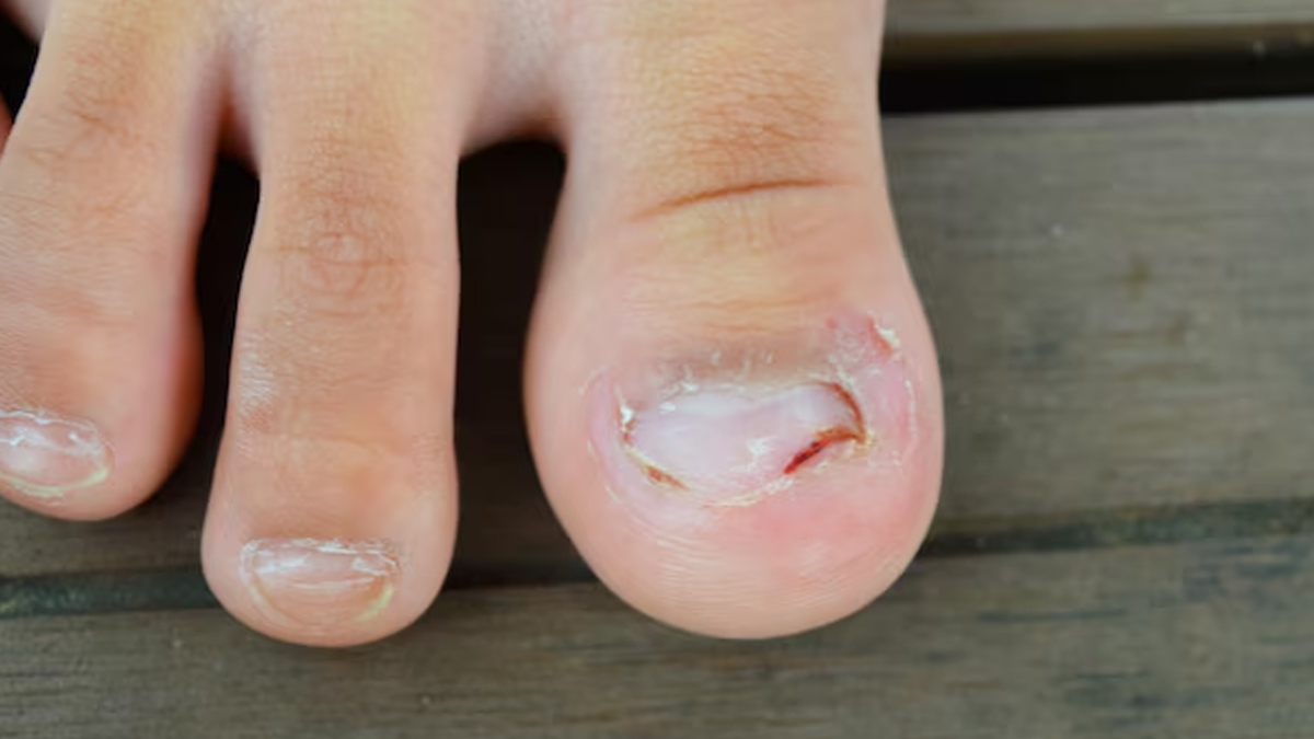 dangers-of-cutting-nails-too-short