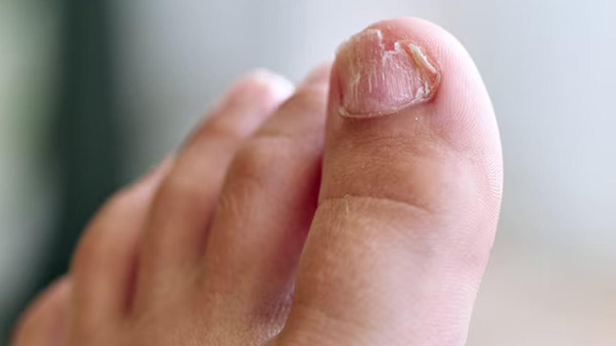 dangers-of-cutting-nails-too-short