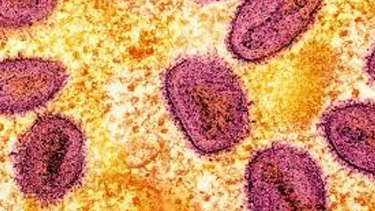 First Case Of New Mpox Variant, Clade 1b, Reported In France
