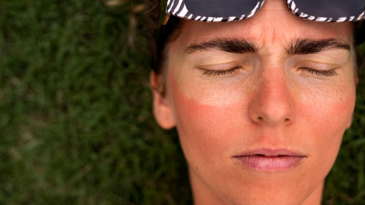 sunburn-skin