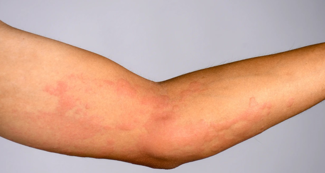 uticaria
