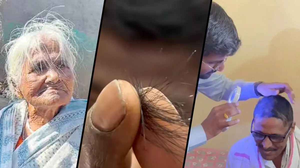 ‘Baldness Virus’ in Maharashtra Village Causes Sudden Hair Loss in Over 100 Due to Fungal Infection: Tips To Care For Scalp