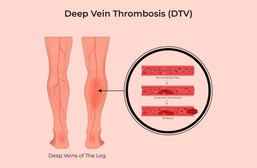 Deep-Vein-Thrombosis