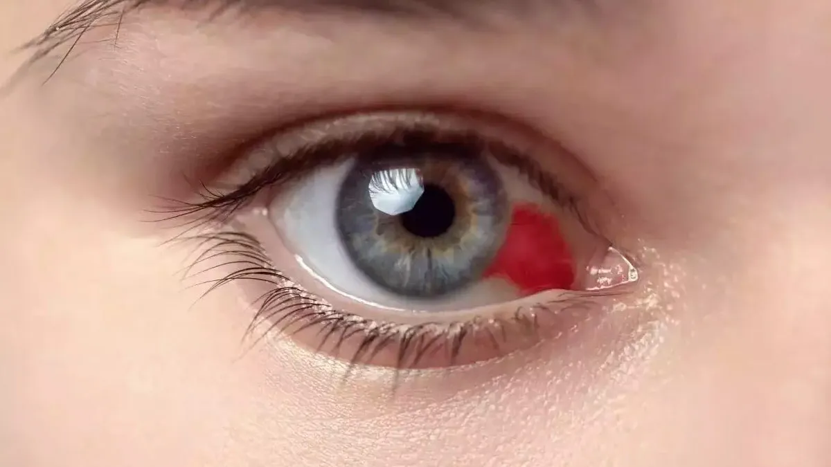 Deadly Ebola-Like Eye-Bleeding Disease Claims 8 Lives in Tanzania; WHO Warns of Global Spread