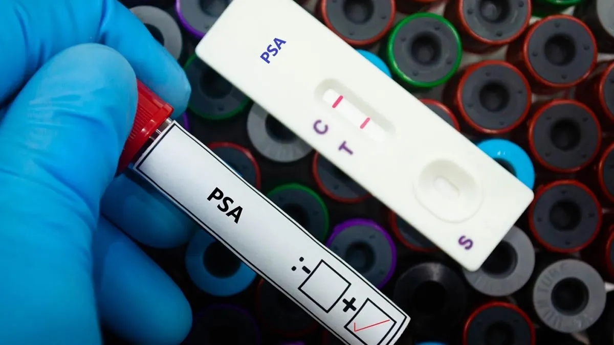 Why PSA Levels Increase After Prostate Cancer Treatment