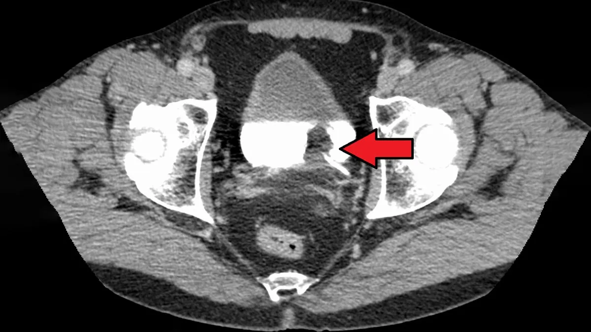 New Study Links Lower Cholesterol to Reduced Spread of Bladder Cancer