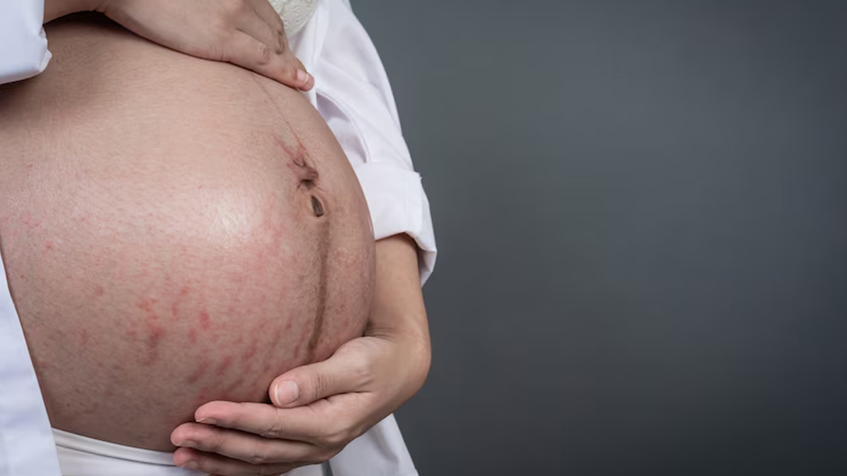 2-skin-problems-pregnancy