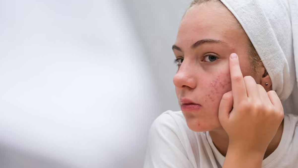 ginger-shots-for-acne