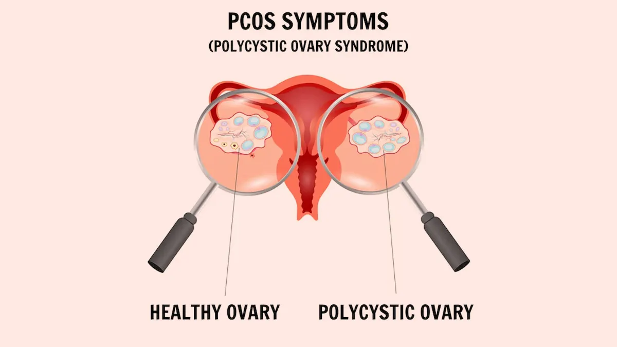 Nutrition and Exercise: Expert Explains How These Two Play A Great Role In PCOS Management And Which Matters More