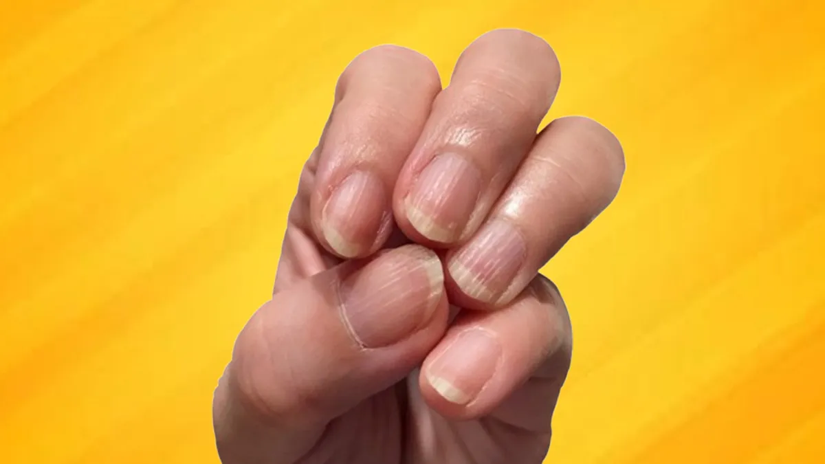Nail Ridges: Here's Why Vertical Or Horizontal Lines Appear On Your Nails