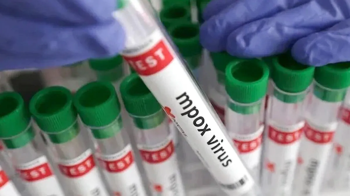 Karnataka Reports First Mpox Case of 2025: Dubai Returnee Tests Positive in Mangaluru