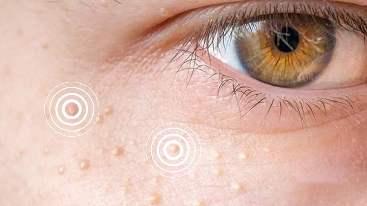 2-Xanthelasma