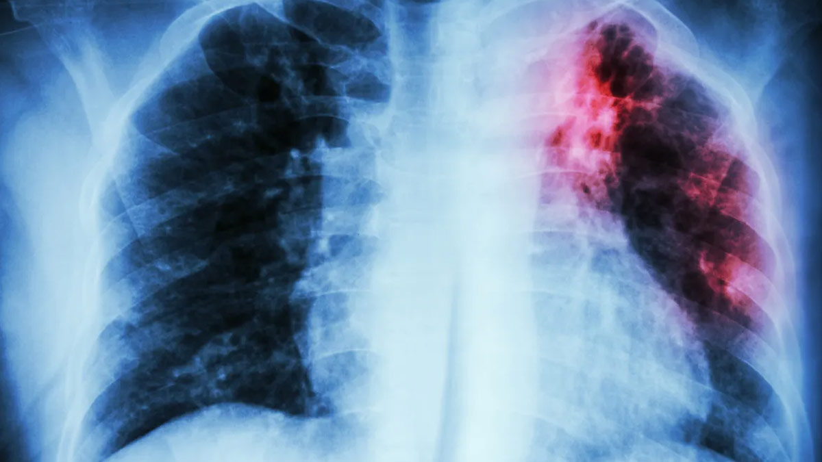 Kansas Faces Largest Tuberculosis Outbreak in US History; CDC Refutes Claims