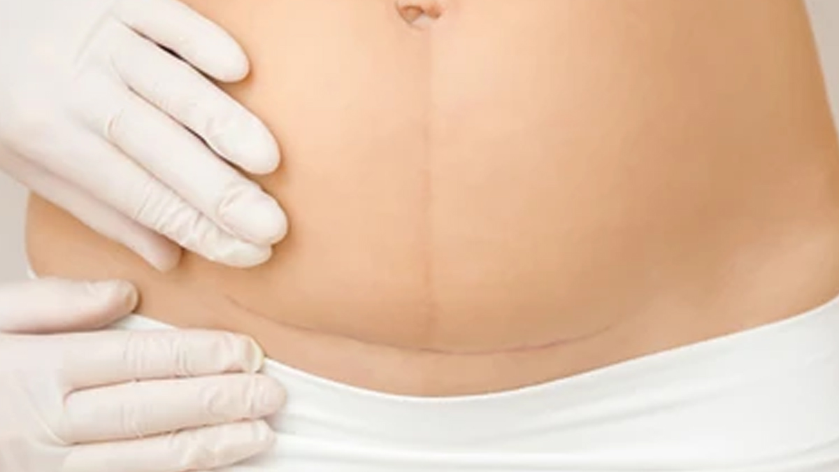 6-natural-vs-c section-birth